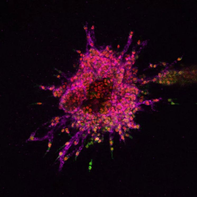 La Fisica che studia l’evoluzione dei tumori